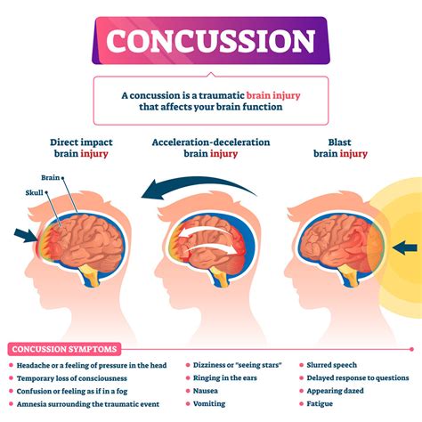 myflixer concussion|Concussion .